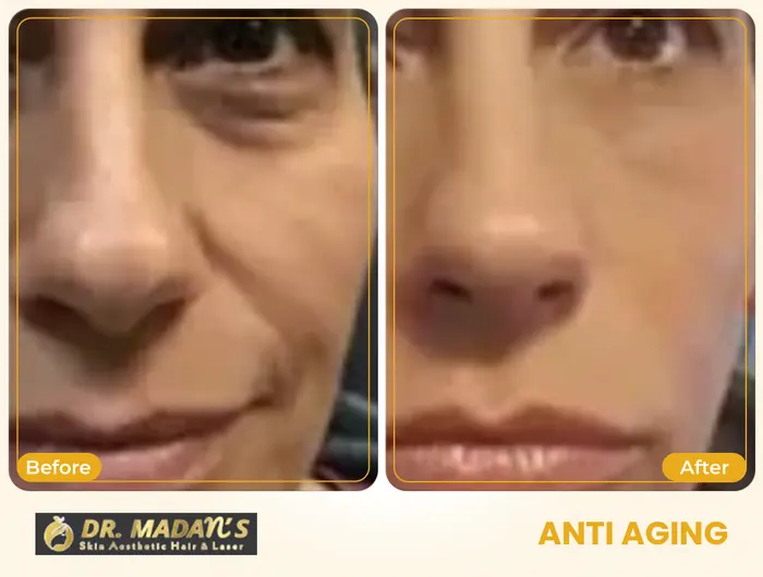 Anti aging before and after result 5 at Dr Madan Aesthetics